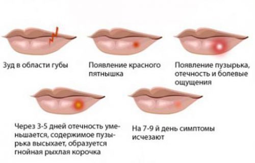 gerpes na gubah u ditini l kuvannya yak viglyada chasto 5 - Герпес на губах у дитини: лікування, як виглядає, часто