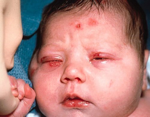 gerpes na gubah u ditini l kuvannya yak viglyada chasto 7 - Герпес на губах у дитини: лікування, як виглядає, часто