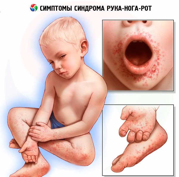 gerpetichna gerpesnaya ang na u d tey prichini simptomi l kuvannya ta prof laktika zahvoryuvannya foto 2 - Герпетична (герпесная) ангіна у дітей: причини і симптоми, лікування та профілактика захворювання + фото