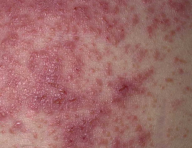 gerpetiformniy dermatit dyuringa simptomi l kuvannya d ta harchuvannya d agnostika 2 - Герпетиформний дерматит Дюринга: симптоми, лікування, дієта і харчування, діагностика