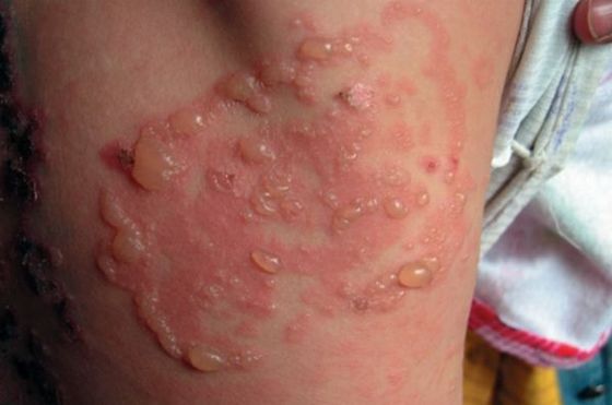 gerpetiformniy dermatit dyuringa simptomi l kuvannya d ta harchuvannya d agnostika 3 - Герпетиформний дерматит Дюринга: симптоми, лікування, дієта і харчування, діагностика