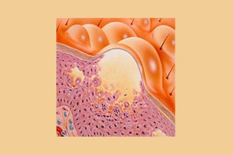 gerpetiformniy dermatit dyuringa simptomi l kuvannya d ta harchuvannya d agnostika 4 - Герпетиформний дерматит Дюринга: симптоми, лікування, дієта і харчування, діагностика