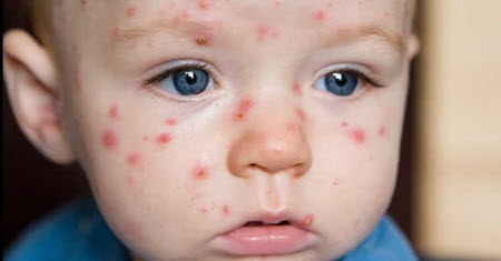 gerpetiformniy dermatit dyuringa simptomi l kuvannya d ta harchuvannya d agnostika 8 - Герпетиформний дерматит Дюринга: симптоми, лікування, дієта і харчування, діагностика