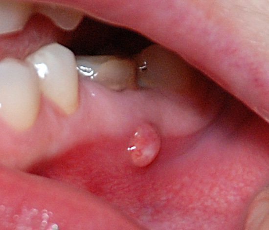gn ynik na desn p slya vidalennya zuba furunkul nariv p slya mplantac 2 - Гнійник на десні після видалення зуба, фурункул, нарив після імплантації