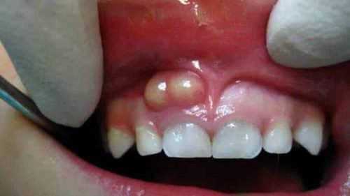 gn ynik na desn p slya vidalennya zuba furunkul nariv p slya mplantac 4 - Гнійник на десні після видалення зуба, фурункул, нарив після імплантації