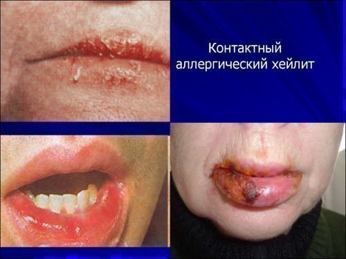 heyl t na gubah l kuvannya maz d agnostika 2 - Хейліт на губах: лікування, мазь, діагностика
