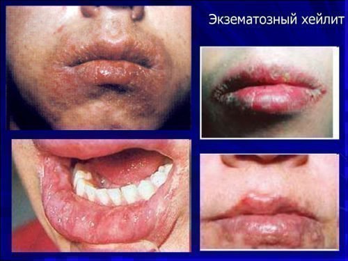 heyl t na gubah l kuvannya maz d agnostika 6 - Хейліт на губах: лікування, мазь, діагностика