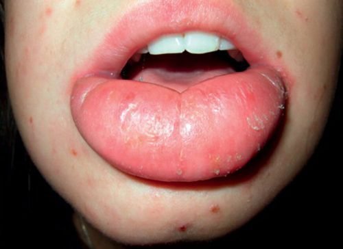 heyl t na gubah zapalennya scho take vseredin zovn simptomi 8 - Хейліт на губах (запалення): що таке, всередині і зовні, симптоми