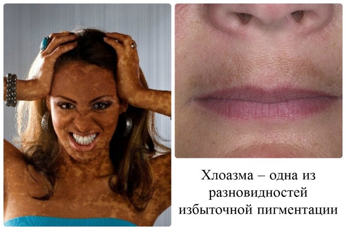 hloazma prichini simptomi foto v deo 2 - Хлоазма: причини, симптоми, фото і відео