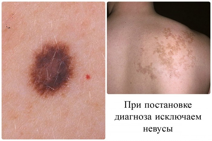 hloazma prichini simptomi foto v deo 3 - Хлоазма: причини, симптоми, фото і відео