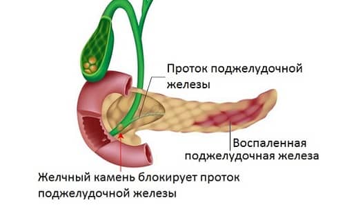 Холецистопанреатит (у чоловіків і жінок): види, причини, симптоми, діагностика, лікування, профілактика, ускладнення і прогноз життя holecistopanreatit u cholov k v zh nok vidi prichini simptomi d agnostika l kuvannya prof laktika uskladnennya prognoz zhittya 3 - Холецистопанреатит (у чоловіків і жінок): види, причини, симптоми, діагностика, лікування, профілактика, ускладнення і прогноз життя