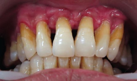 hron chniy parodontit l kuvannya pri zagostrenn simptomi 2 - Хронічний пародонтит: лікування при загостренні, симптоми