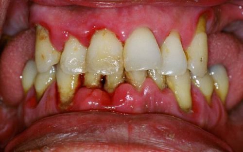 hron chniy parodontit l kuvannya pri zagostrenn simptomi 3 - Хронічний пародонтит: лікування при загостренні, симптоми