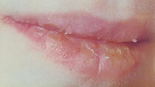 hvorobi gub prichini simptomi r znovidi ta l kuvannya 5 - Хвороби губ: причини, симптоми, різновиди та лікування