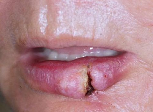 hvorobi gub prichini simptomi r znovidi ta l kuvannya 8 - Хвороби губ: причини, симптоми, різновиди та лікування