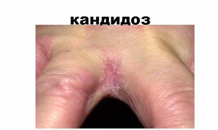 КАНДИСАН – інструкція із застосування, ціна, відгуки і аналоги kandisan nstrukc ya z zastosuvannya c na v dguki analogi 3 - КАНДИСАН – інструкція із застосування, ціна, відгуки і аналоги