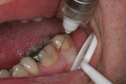 karpul naya anestez ya v stomatolog scho take perevagi nedol ki 2 - Карпульная анестезія в стоматології: що таке, переваги і недоліки