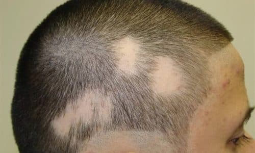 КЕТОЗОРАЛ – інструкція із застосування, ціна, відгуки і аналоги ketozoral nstrukc ya z zastosuvannya c na v dguki analogi 14 - КЕТОЗОРАЛ – інструкція із застосування, ціна, відгуки і аналоги