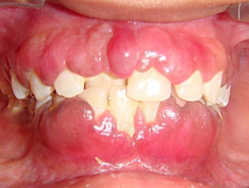 klasif kac ya zahvoryuvan parodontu g ng v t parodontit parodontoz 5 - Класифікація захворювань пародонту: гінгівіт, пародонтит, пародонтоз