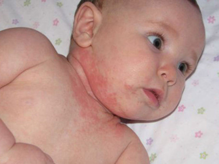 kontaktniy dermatit u doroslih d tey simptomi l kuvannya osoblivo na rukah na oblichch foto 13 - Контактний дерматит у дорослих і дітей: симптоми і лікування, особливо на руках і на обличчі, фото