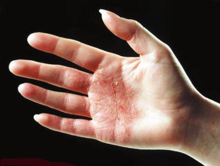 kontaktniy dermatit u doroslih d tey simptomi l kuvannya osoblivo na rukah na oblichch foto 5 - Контактний дерматит у дорослих і дітей: симптоми і лікування, особливо на руках і на обличчі, фото