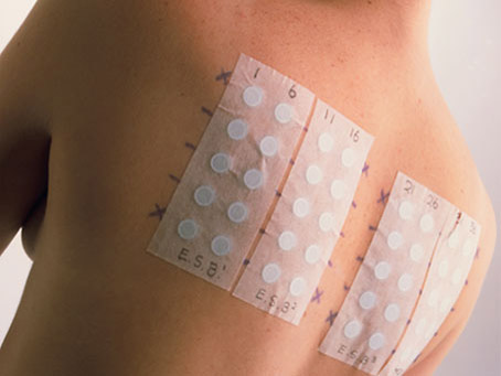 kontaktniy dermatit u doroslih d tey simptomi l kuvannya osoblivo na rukah na oblichch foto 6 - Контактний дерматит у дорослих і дітей: симптоми і лікування, особливо на руках і на обличчі, фото