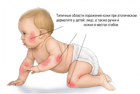 l kuvannya alerg u nemovlyat novonarodzhenih medikamentozna terap ya ta zastosuvannya narodnih zasob v 7 - Лікування алергії у немовлят і новонароджених: медикаментозна терапія та застосування народних засобів