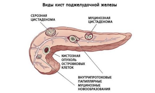 Лікування кісти підшлункової залози (консервативне, хірургічне, народними засобами, дієтою), його ускладнення, прогноз життя та відгуки l kuvannya k sti p dshlunkovo zalozi konservativne h rurg chne narodnimi zasobami d toyu yogo uskladnennya prognoz zhittya ta v dguki 1 - Лікування кісти підшлункової залози (консервативне, хірургічне, народними засобами, дієтою), його ускладнення, прогноз життя та відгуки