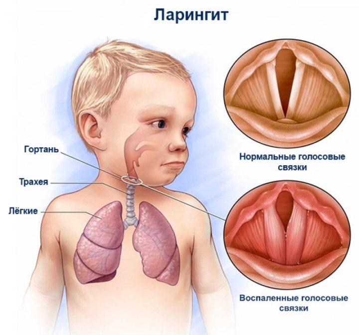 l kuvannya laring tu u d tey bazov principi medikamentozna terap ya f z oterapevtichn metodi ngalyac toscho d ta narodn zasobi v deo 2 - Лікування ларингіту у дітей: базові принципи, медикаментозна терапія, фізіотерапевтичні методи (інгаляції тощо), дієта, народні засоби + відео