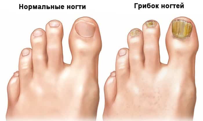 ЛАМІКОН ® – інструкція із застосування, ціна, відгуки і аналоги lam kon nstrukc ya z zastosuvannya c na v dguki analogi 4 - ЛАМІКОН ® – інструкція із застосування, ціна, відгуки і аналоги