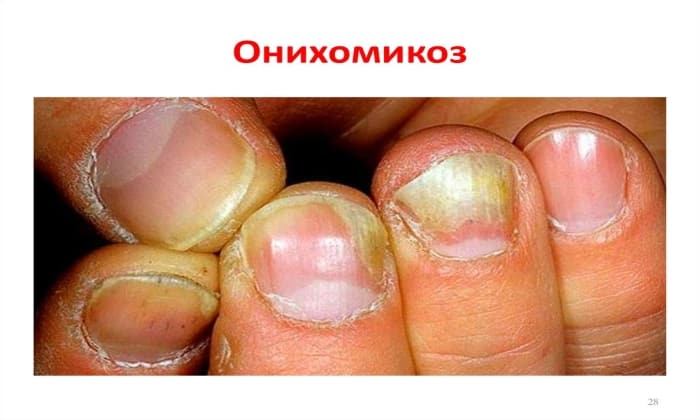 lam zil 250 nstrukc ya z zastosuvannya c na v dguki analogi 6 - ЛАМІЗИЛ 250 – інструкція із застосування, ціна, відгуки і аналоги