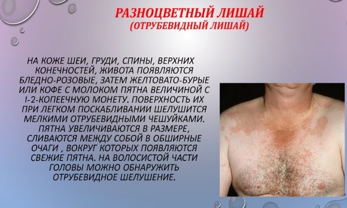 ЛАМИДЕРМ – інструкція із застосування, ціна, відгуки і аналоги lamiderm nstrukc ya z zastosuvannya c na v dguki analogi 3 - ЛАМИДЕРМ – інструкція із застосування, ціна, відгуки і аналоги