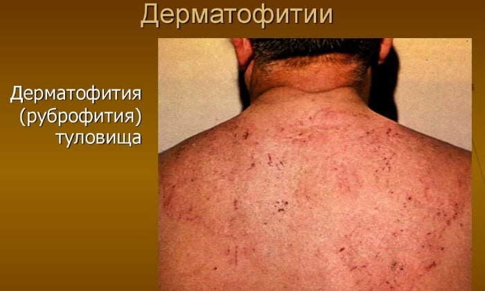 ЛАМИДЕРМ – інструкція із застосування, ціна, відгуки і аналоги lamiderm nstrukc ya z zastosuvannya c na v dguki analogi 4 - ЛАМИДЕРМ – інструкція із застосування, ціна, відгуки і аналоги