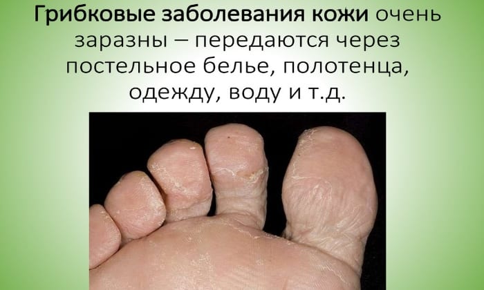 ЛАМИДЕРМ – інструкція із застосування, ціна, відгуки і аналоги lamiderm nstrukc ya z zastosuvannya c na v dguki analogi 5 - ЛАМИДЕРМ – інструкція із застосування, ціна, відгуки і аналоги