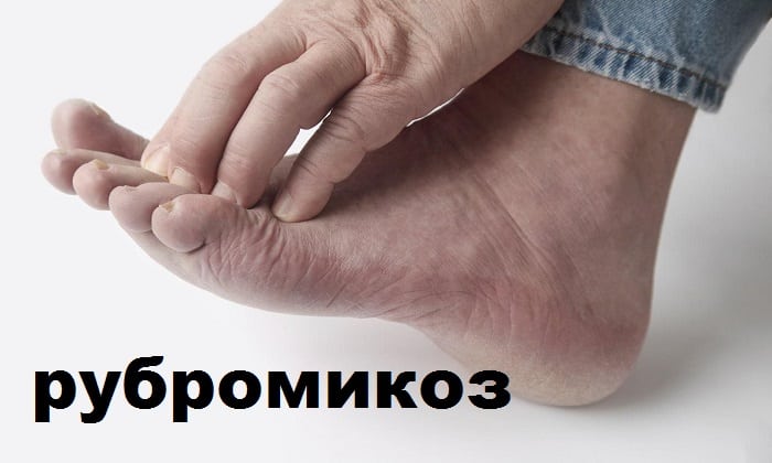 ЛАМИТЕЛЬ – інструкція із застосування, ціна, відгуки і аналоги lamitel nstrukc ya z zastosuvannya c na v dguki analogi 2 - ЛАМИТЕЛЬ – інструкція із застосування, ціна, відгуки і аналоги
