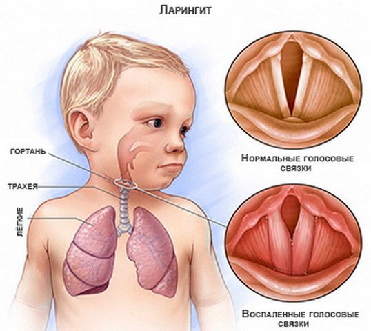 laring t u novonarodzhenih nemovlyat prichini viniknennya simptomi d agnostika l kuvannya uskladnennya ta zahodi prof laktiki 2 - Ларингіт у новонароджених і немовлят: причини виникнення, симптоми, діагностика, лікування, ускладнення та заходи профілактики
