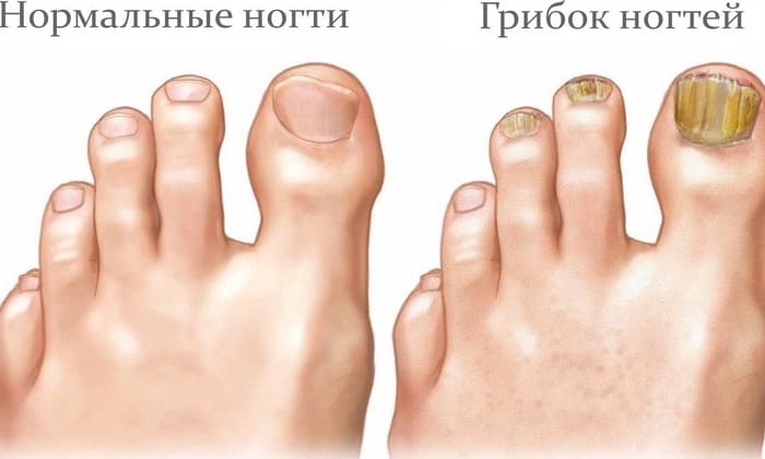 ЛОЦЕРІЛ або ОФЛОМИЛ: що краще і в чому різниця (відмінність складів, відгуки лікарів) locer l abo oflomil scho krasche v chomu r znicya v dm nn st sklad v v dguki l kar v 7 - ЛОЦЕРІЛ або ОФЛОМИЛ: що краще і в чому різниця (відмінність складів, відгуки лікарів)