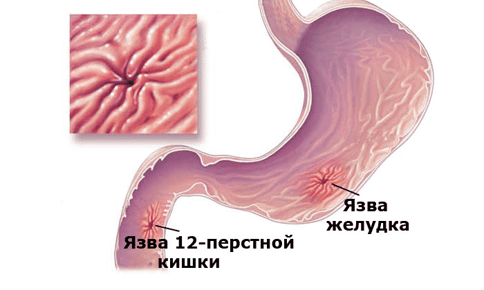 ЛОТРИДЕРМ – інструкція із застосування, ціна, відгуки і аналоги lotriderm nstrukc ya z zastosuvannya c na v dguki analogi 3 - ЛОТРИДЕРМ – інструкція із застосування, ціна, відгуки і аналоги