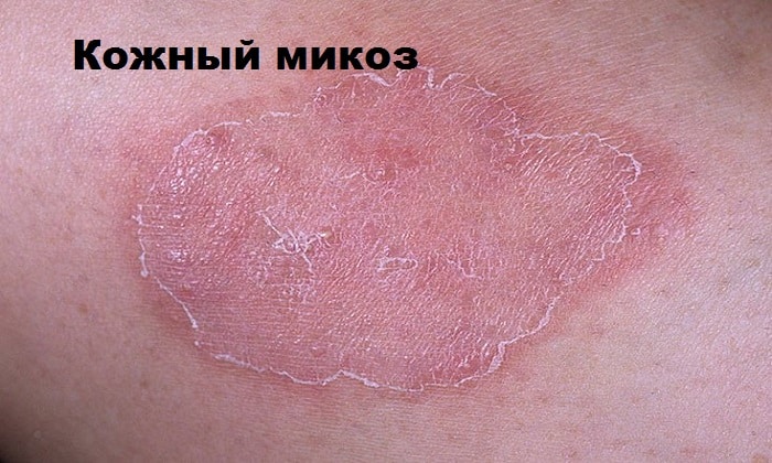 m komaks nstrukc ya z zastosuvannya c na v dguki analogi 6 - МІКОМАКС – Інструкція із застосування, ціна, відгуки і аналоги