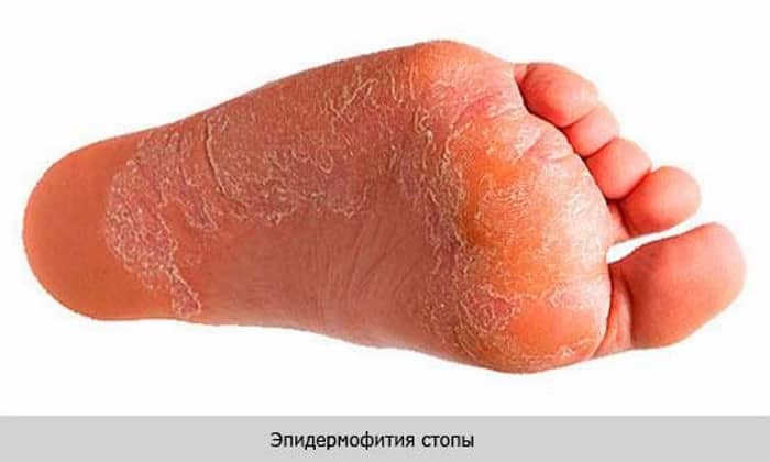 МАЗЬ або КРЕМ ТРИДЕРМ: що краще і в чому різниця (відмінність складів, відгуки лікарів) maz abo krem triderm scho krasche v chomu r znicya v dm nn st sklad v v dguki l kar v 4 - МАЗЬ або КРЕМ ТРИДЕРМ: що краще і в чому різниця (відмінність складів, відгуки лікарів)