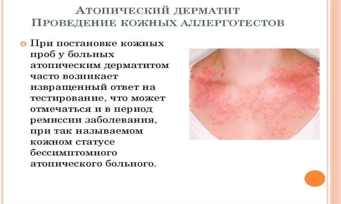 МАЗЬ або КРЕМ ТРИДЕРМ: що краще і в чому різниця (відмінність складів, відгуки лікарів) maz abo krem triderm scho krasche v chomu r znicya v dm nn st sklad v v dguki l kar v 7 - МАЗЬ або КРЕМ ТРИДЕРМ: що краще і в чому різниця (відмінність складів, відгуки лікарів)