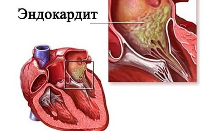 МЕТРОНІДАЗОЛ 250 – інструкція із застосування, ціна, відгуки і аналоги metron dazol 250 nstrukc ya z zastosuvannya c na v dguki analogi 5 - МЕТРОНІДАЗОЛ 250 – інструкція із застосування, ціна, відгуки і аналоги