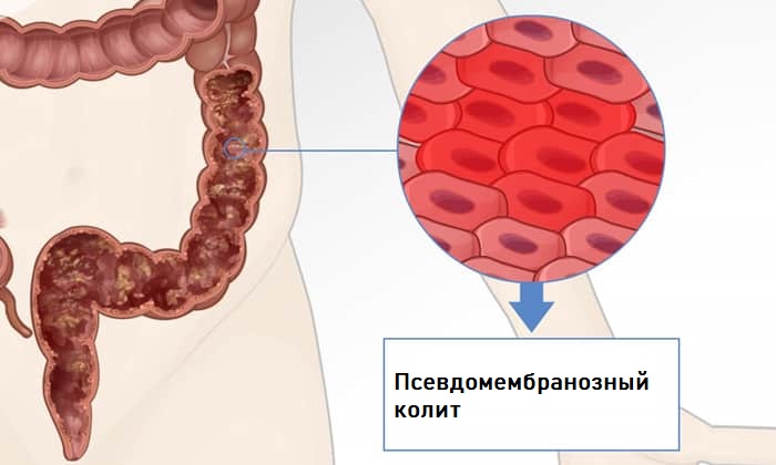 МЕТРОНІДАЗОЛ 250 – інструкція із застосування, ціна, відгуки і аналоги metron dazol 250 nstrukc ya z zastosuvannya c na v dguki analogi 8 - МЕТРОНІДАЗОЛ 250 – інструкція із застосування, ціна, відгуки і аналоги