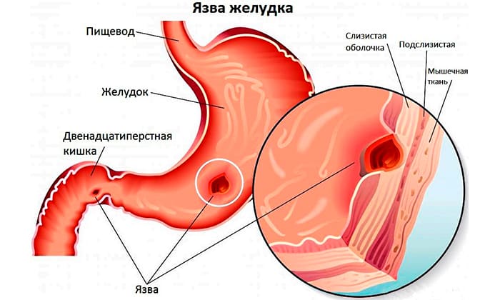 metron dazol 500 nstrukc ya z zastosuvannya c na v dguki analogi 3 - МЕТРОНІДАЗОЛ 500 – інструкція із застосування, ціна, відгуки і аналоги