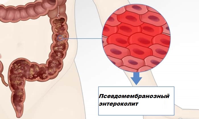 МЕТРОНІДАЗОЛ НІКОМЕД – інструкція із застосування, ціна, відгуки і аналоги metron dazol n komed nstrukc ya z zastosuvannya c na v dguki analogi 11 - МЕТРОНІДАЗОЛ НІКОМЕД – інструкція із застосування, ціна, відгуки і аналоги