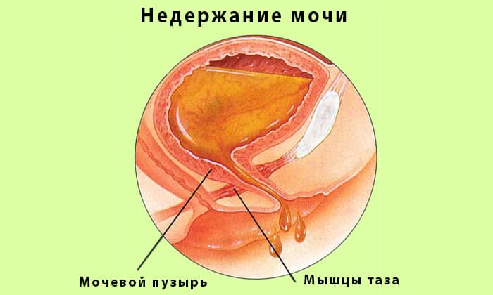 МЕТРОНІДАЗОЛ НІКОМЕД – інструкція із застосування, ціна, відгуки і аналоги metron dazol n komed nstrukc ya z zastosuvannya c na v dguki analogi 29 - МЕТРОНІДАЗОЛ НІКОМЕД – інструкція із застосування, ціна, відгуки і аналоги