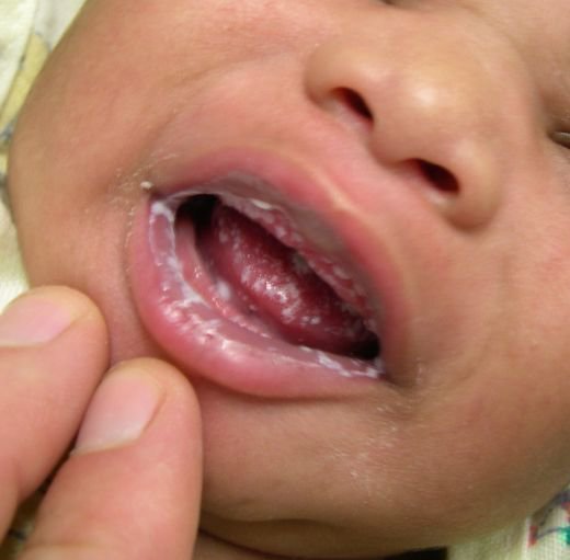 molochnicya na gubah u ditini nemovlya l kuvannya 1 - Молочниця на губах: у дитини, немовля, лікування