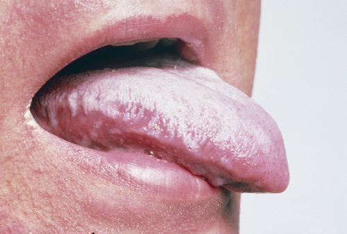molochnicya na gubah u doroslih kandidozniy heyl t l kuvannya 1 - Молочниця на губах: у дорослих, кандидозний хейліт, лікування