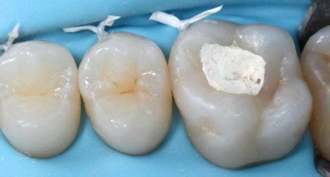 mozhna paliti p slya plombuvannya zuba timchasovo plombi 7 - Можна палити після пломбування зуба і тимчасової пломби