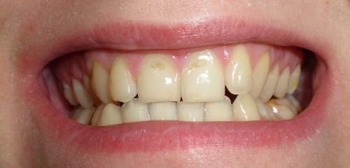 mplantac ya emal zub v tehnolog ya metodu prof laktika ruynuvannya 2 - Імплантація емалі зубів: технологія методу, профілактика руйнування